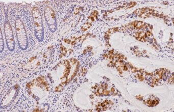 The MUC2 IHC test detects intestinal goblet-cell mucin. Learn what positive staining means in colorectal, appendiceal, pancreatic, and mucinous tumors and how MUC2 fits into IHC panels.