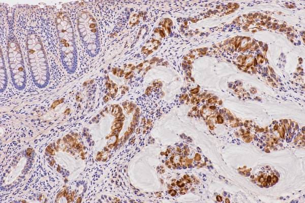 MUC2 IHC Test: GI Tumor Marker, Mucinous Cancer, and Intestinal Type The MUC2 IHC test detects intestinal goblet-cell mucin. Learn what positive staining means in colorectal, appendiceal, pancreatic, and mucinous tumors and how MUC2 fits into IHC panels.