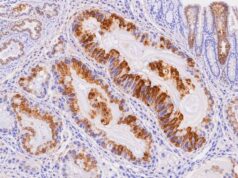 The MUC5AC IHC test detects gastric-type mucin in pancreatic, gastric, and other mucinous tumors. Learn what positive staining means, common patterns, uses, and limitations.