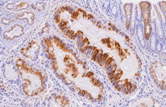 The MUC5AC IHC test detects gastric-type mucin in pancreatic, gastric, and other mucinous tumors. Learn what positive staining means, common patterns, uses, and limitations.