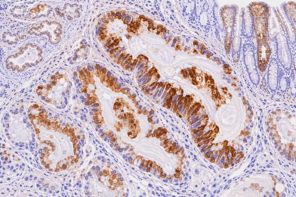 MUC5AC IHC Test: Pancreatic, Gastric, and Mucinous Tumor Marker The MUC5AC IHC test detects gastric-type mucin in pancreatic, gastric, and other mucinous tumors. Learn what positive staining means, common patterns, uses, and limitations.