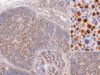 The MUM1/IRF4 IHC test helps identify activated B-cell and plasma-cell differentiation. Learn what positive staining means in DLBCL, myeloma, plasmablastic tumors, and other lymphomas.
