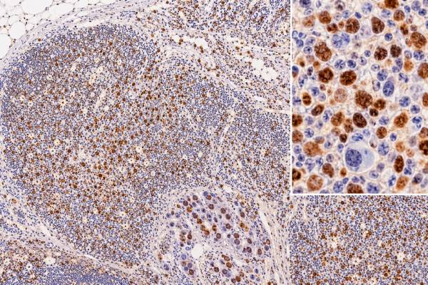 MUM1 IHC Test Lymphoma Marker, Plasma Cell Differentiation, and Positive Staining The MUM1/IRF4 IHC test helps identify activated B-cell and plasma-cell differentiation. Learn what positive staining means in DLBCL, myeloma, plasmablastic tumors, and other lymphomas.
