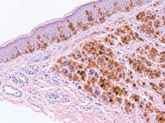 The Melan-A (MART-1) IHC test helps identify melanocytic differentiation. Learn what positive staining means, how it supports melanoma diagnosis, key panel markers, and major pitfalls.