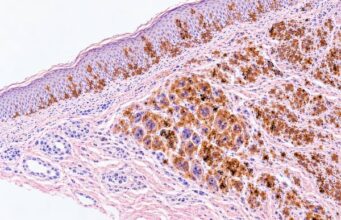 The Melan-A (MART-1) IHC test helps identify melanocytic differentiation. Learn what positive staining means, how it supports melanoma diagnosis, key panel markers, and major pitfalls.