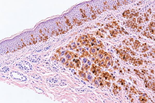 Melan-A IHC Test: Melanoma Marker, Melanocytic Tumors, and Positive Staining The Melan-A (MART-1) IHC test helps identify melanocytic differentiation. Learn what positive staining means, how it supports melanoma diagnosis, key panel markers, and major pitfalls.