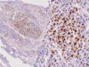 Understand what a positive MyoD1 IHC stain means in rhabdomyosarcoma and sarcoma diagnosis, including nuclear staining, myogenin and desmin, MYOD1 mutation testing, and key limitations.