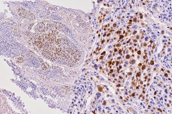 MyoD1 IHC Test Rhabdomyosarcoma Marker, Sarcoma Diagnosis, and Positive Staining Understand what a positive MyoD1 IHC stain means in rhabdomyosarcoma and sarcoma diagnosis, including nuclear staining, myogenin and desmin, MYOD1 mutation testing, and key limitations.