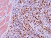 Learn what positive myogenin IHC means in rhabdomyosarcoma, including nuclear staining, skeletal-muscle differentiation, subtype patterns, MyoD1 and desmin comparisons, and molecular testing limits.