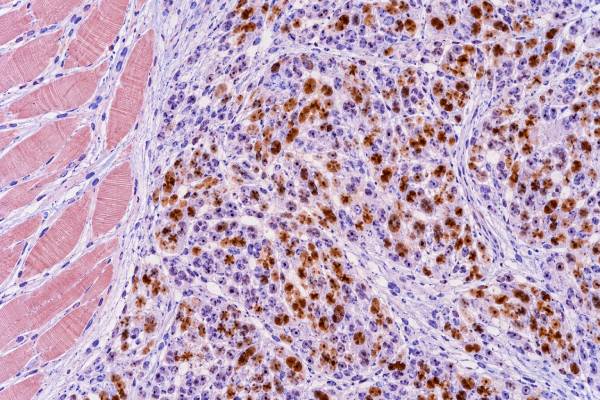Myogenin IHC Test Rhabdomyosarcoma Marker, Skeletal Muscle Differentiation, and Positive Staining Learn what positive myogenin IHC means in rhabdomyosarcoma, including nuclear staining, skeletal-muscle differentiation, subtype patterns, MyoD1 and desmin comparisons, and molecular testing limits.