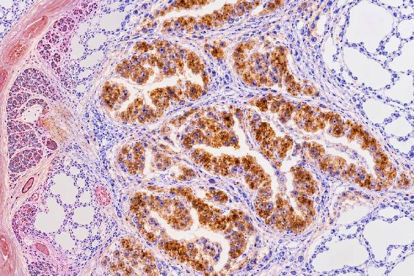Napsin A IHC Test: Lung Adenocarcinoma Marker, Tumor Origin, and Positive Staining