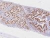Learn what an OCT4 IHC test means, how nuclear OCT4 staining supports seminoma or embryonal carcinoma, and why marker panels are needed for diagnosis.