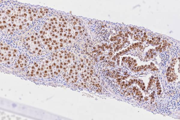 OCT4 IHC Test: Germ Cell Tumor Marker, Seminoma, Embryonal Carcinoma, and Positive Staining Learn what an OCT4 IHC test means, how nuclear OCT4 staining supports seminoma or embryonal carcinoma, and why marker panels are needed for diagnosis.