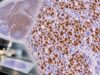 Learn how PAX5 IHC identifies B-cell lineage, what positive nuclear staining means in lymphoma, and why PAX5 must be interpreted with a full immunophenotypic panel.