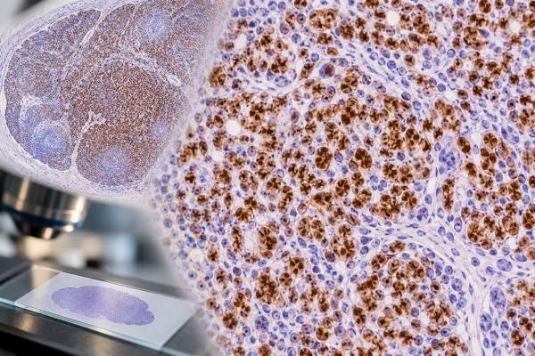 PAX5 IHC Test: B-Cell Lymphoma Marker, B-Cell Lineage, and Tumor Classification Learn how PAX5 IHC identifies B-cell lineage, what positive nuclear staining means in lymphoma, and why PAX5 must be interpreted with a full immunophenotypic panel.