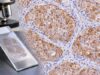 Understand what PLAP IHC positivity means, how PLAP supports seminoma and other germ cell tumors, and why modern marker panels are needed for accurate diagnosis.