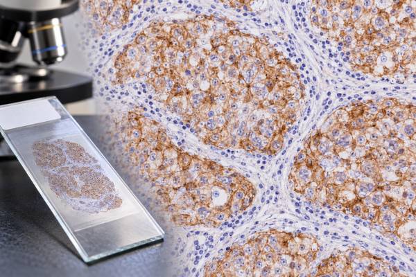 PLAP IHC Test: Germ Cell Tumor Marker, Seminoma Pattern, and Positive Staining Understand what PLAP IHC positivity means, how PLAP supports seminoma and other germ cell tumors, and why modern marker panels are needed for accurate diagnosis.