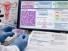 POLE Mutation Test for Endometrial Cancer: Molecular Subtype, Prognosis, and Mutation Meaning Learn how POLE mutation testing classifies endometrial cancer, which exonuclease-domain variants matter, and what POLE-mutated results mean for prognosis and treatment.