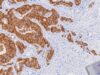 Learn what pancytokeratin IHC positive staining means, how broad keratin stains help identify carcinoma, and why additional markers are needed to determine tumor origin.