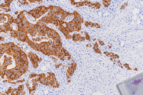 Pancytokeratin IHC Test: Epithelial Tumors, Carcinoma Marker, and Positive Staining Learn what pancytokeratin IHC positive staining means, how broad keratin stains help identify carcinoma, and why additional markers are needed to determine tumor origin.