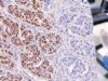 Learn how progesterone receptor (PR) IHC is scored in breast cancer, what PR positive and negative results mean, and how PR fits with ER and HER2 status.