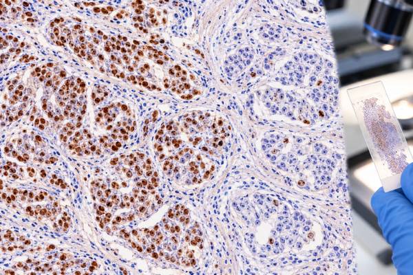 Progesterone Receptor (PR) IHC Test: Breast Cancer Hormone Receptor Status and Positive Score Learn how progesterone receptor (PR) IHC is scored in breast cancer, what PR positive and negative results mean, and how PR fits with ER and HER2 status.
