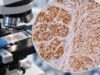 Learn what S100 IHC positive staining means in melanoma and nerve sheath tumors, why S100 is sensitive but not specific, and which companion markers help confirm diagnosis.