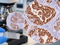 SALL4 IHC Test: Germ Cell Tumor Marker, Embryonal Pattern, and Positive Staining Learn what SALL4 IHC positive nuclear staining means, which germ cell tumors express SALL4, key mimics, companion markers, and common interpretation pitfalls.