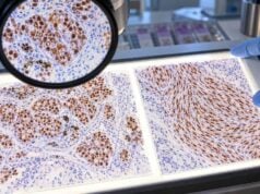 SOX10 IHC Test: Melanoma, Nerve Sheath Tumor, Tumor Origin, and Positive Staining Learn what SOX10 IHC positive nuclear staining means in melanoma and nerve sheath tumors, major non-melanoma pitfalls, companion markers, and limitations.
