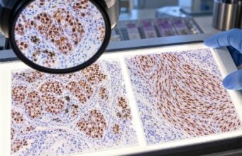 SOX10 IHC Test: Melanoma, Nerve Sheath Tumor, Tumor Origin, and Positive Staining Learn what SOX10 IHC positive nuclear staining means in melanoma and nerve sheath tumors, major non-melanoma pitfalls, companion markers, and limitations.