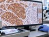Learn what synaptophysin IHC positive staining means, how it supports neuroendocrine differentiation, how NETs and NECs are classified, and key pitfalls.