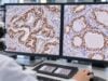 TTF-1 IHC Test: Lung Cancer, Thyroid Cancer, Tumor Origin, and Positive Staining Learn what TTF-1 IHC positive nuclear staining means in lung and thyroid cancer, how Napsin A and PAX8 help, and why false-positive or negative results occur.
