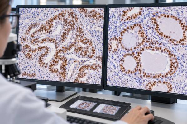 TTF-1 IHC Test: Lung Cancer, Thyroid Cancer, Tumor Origin, and Positive Staining Learn what TTF-1 IHC positive nuclear staining means in lung and thyroid cancer, how Napsin A and PAX8 help, and why false-positive or negative results occur.