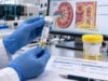 Urine Ammonium Test: Kidney Acid Excretion and Metabolic Acidosis Evaluation Learn how urine ammonium measures kidney acid excretion, why low levels matter in renal tubular acidosis and CKD, and how direct NH₄⁺ testing compares with the urine anion and osmolal gaps.
