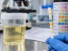 Urine Blood Dipstick Test: Positive Blood, Hematuria, Causes, and Follow-Up Understand urine blood dipstick test: positive blood, hematuria, causes, and follow-up, including what the result measures, common causes, false results, confirmatory testing, and when medical follow-up matters.