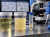 Urine Clarity Test: Cloudy Urine, Sediment, Infection, and Abnormal Findings Understand urine clarity test: cloudy urine, sediment, infection, and abnormal findings, including what the result measures, common causes, false results, confirmatory testing, and when medical follow-up matters.