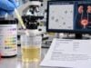 Urine Leukocyte Esterase Test: Positive Result, UTI, White Blood Cells, and Meaning Learn what a positive urine leukocyte esterase test means, how it relates to white blood cells and UTI, common false results, and when culture or follow-up is needed.