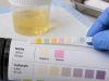 Urine Nitrite Test for UTI: Positive Result, Bacteria, and Infection Meaning Understand urine nitrite test results for UTI, including what a positive or negative result means, which bacteria make nitrite, false negatives, and when culture is needed.