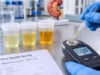 Learn what urine specific gravity measures, what high or low values can mean, how hydration and kidney concentrating ability affect results, and when urine osmolality is more informative.