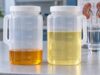 A urine volume test shows whether urine output is low enough to concentrate stone-forming minerals and helps guide hydration targets for kidney stone prevention.