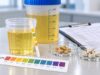 Learn how urine pH affects uric acid, calcium phosphate, and struvite stones, what acidic or alkaline results mean, and how pH is tested and followed safely.