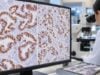 WT1 IHC Test: Ovarian Cancer, Mesothelioma, Tumor Origin, and Positive Staining Learn what WT1 IHC positive nuclear staining means in ovarian serous carcinoma and mesothelioma, how panels distinguish them, and which pitfalls matter.