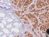 Learn what a p40 IHC test shows, why nuclear p40 supports squamous cell carcinoma, how it helps type lung tumors, and what positive or negative staining means.