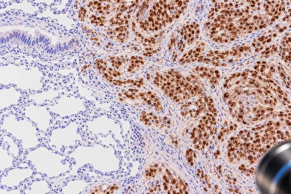 p40 IHC Test: Squamous Cell Carcinoma Marker, Lung Tumor Typing, and Positive Staining Learn what a p40 IHC test shows, why nuclear p40 supports squamous cell carcinoma, how it helps type lung tumors, and what positive or negative staining means.