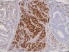 Learn how p53 IHC is interpreted, what wild-type, overexpression, null, and cytoplasmic patterns mean, and how p53 helps classify tumors and infer TP53 status.
