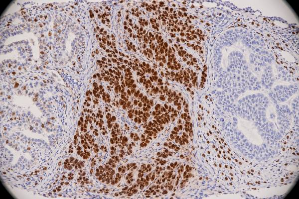 p53 IHC Test: Tumor Suppressor Marker, Abnormal Staining, and Cancer Subtype Learn how p53 IHC is interpreted, what wild-type, overexpression, null, and cytoplasmic patterns mean, and how p53 helps classify tumors and infer TP53 status.
