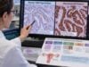 p53 Test for Endometrial Cancer: Tumor Subtype, Abnormal Staining, and Prognosis Learn how p53 IHC classifies endometrial cancer, what wild-type, overexpression, null, and cytoplasmic patterns mean, and why p53-abnormal tumors carry higher risk on average.