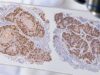 Learn what p63 IHC staining means in squamous and urothelial cancer, how p63 highlights myoepithelial cells, and why p40 and other markers may be needed.