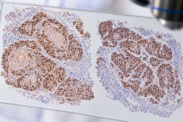 p63 IHC Test: Squamous Cell Cancer, Urothelial Cancer, Tumor Origin, and Staining Meaning Learn what p63 IHC staining means in squamous and urothelial cancer, how p63 highlights myoepithelial cells, and why p40 and other markers may be needed.